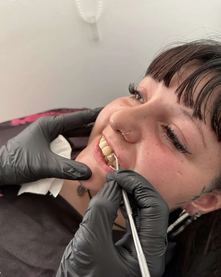 Gema dental colocada en el Curso de Gemas Dentales de la escuela ESAP de Madrid Gema dental colocada en el Curso de Gemas Dentales de la escuela ESAP de Madrid