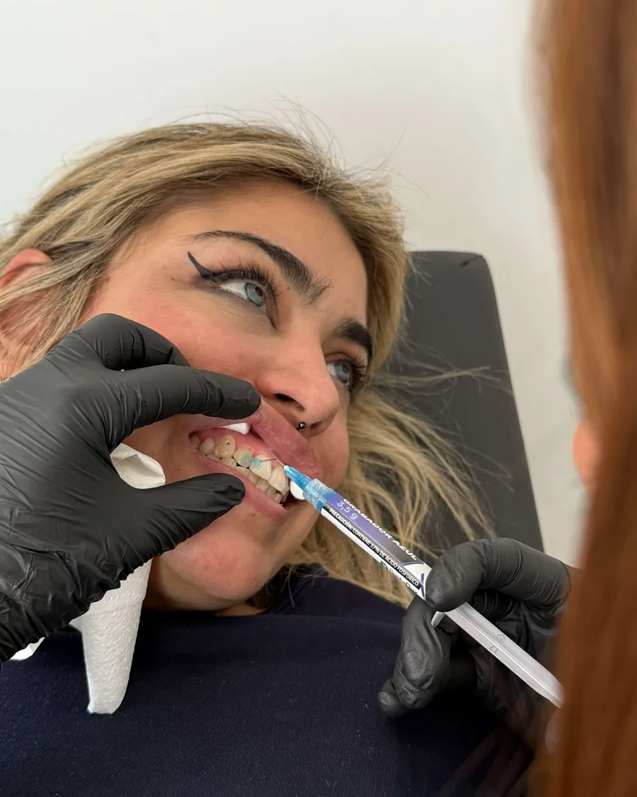 Colocación de una gema dental en el Curso de Gemas Dentales de la escuela ESAP de Madrid Colocación de una gema dental en el Curso de Gemas Dentales de la escuela ESAP de Madrid